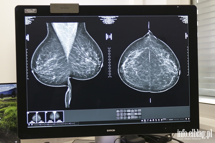 Szpital Wojewdzki-nowy mammograf, fot. 3
